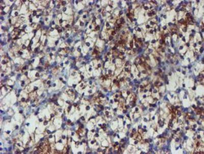 Immunohistochemistry-Paraffin: Phosphoribosyl Pyrophosphate Amidotransferase Antibody (1B8) [NBP2-02056] - Staining of paraffin-embedded Carcinoma of Human kidney tissue using anti-Phosphoribosyl Pyrophosphate Amidotransferase mouse monoclonal antibody.