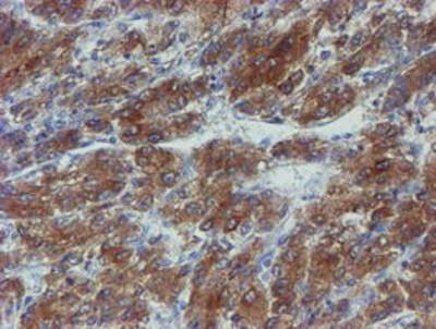 Immunohistochemistry-Paraffin: Phosphoribosyl Pyrophosphate Amidotransferase Antibody (1B8) [NBP2-02056] - Staining of paraffin-embedded Carcinoma of Human liver tissue using anti-Phosphoribosyl Pyrophosphate Amidotransferase mouse monoclonal antibody.