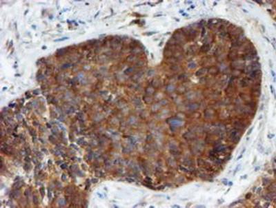 Immunohistochemistry-Paraffin: Phosphoribosyl Pyrophosphate Amidotransferase Antibody (1B8) [NBP2-02056] - Staining of paraffin-embedded Carcinoma of Human lung tissue using anti-Phosphoribosyl Pyrophosphate Amidotransferase mouse monoclonal antibody.