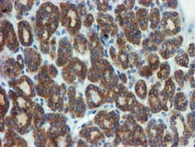 Immunohistochemistry-Paraffin: Phosphoribosyl Pyrophosphate Amidotransferase Antibody (1B8) [NBP2-02056] - Staining of paraffin-embedded Carcinoma of Human thyroid tissue using anti-Phosphoribosyl Pyrophosphate Amidotransferase mouse monoclonal antibody.