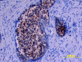 Kallikrein 11 was detected in immersion fixed paraffin-embedded sections of human prostate using Goat Anti-Human Kallikrein 11 Antigen Affinity-purified Polyclonal Antibody (Catalog # AF1595) at 10 µg/mL overnight at 4 °C. Tissue was stained using the Anti-Goat HRP-DAB Cell & Tissue Staining Kit (brown; Catalog # CTS008) and counterstained with hematoxylin (blue). View our protocol for Chromogenic IHC Staining of Paraffin-embedded Tissue Sections.