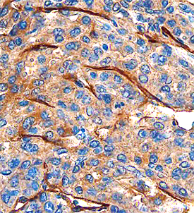CLEC14A was detected in formalin fixed paraffin-embedded sections of human breast cancer tissue using Sheep Anti-Human CLEC14A Antigen Affinity-purified Polyclonal Antibody (Catalog # AF4968) at 1.7 µg/mL overnight at4 °C. Before incubation with the primary antibody, tissue was subjected to heat-induced epitope retrieval using Antigen Retrieval Reagent-Universal (Catalog # CTS015). Tissue was stained using the Anti-Sheep HRP-DAB Cell & Tissue Staining Kit (brown; Catalog # CTS019) and counterstained with hematoxylin (blue). Specific staining was localized to endothelial cells. View our protocol for Chromogenic IHC Staining of Paraffin-embedded Tissue Sections. 