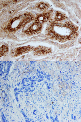 CELSR2 was detected in immersion fixed paraffin-embedded sections of human breast using Goat Anti-Human CELSR2 Antigen Affinity-purified Polyclonal Antibody (Catalog # AF6739) at 10 µg/mL overnight at 4 °C. Tissue was stained using the Anti-Goat HRP-DAB Cell & Tissue Staining Kit (brown; Catalog # CTS008) and counterstained with hematoxylin (blue). Lower panel shows a lack of labeling when primary antibodies are omitted and tissue is stained only with secondary antibody followed by incubation with detection reagents. Specific staining was localized to ductal epithelium. View our protocol for Chromogenic IHC Staining of Paraffin-embedded Tissue Sections.