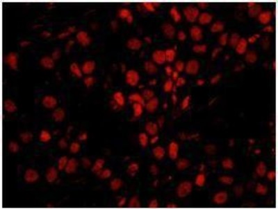 Immunocytochemistry/Immunofluorescence: Smek1 Antibody [NB100-2879] - FFPE section of human breast carcinoma.  Affinity purified rabbit anti-PPP4R3 Alpha used at a dilution of 1:250. Detection: Red-fluorescent goat anti-rabbit IgG highly cross-adsorbed Antibody Hilyte PlusTM 555 used at a dilution of 1:100.