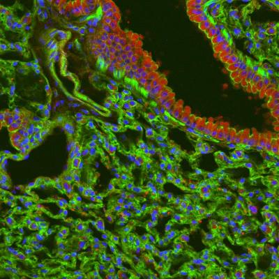 Immunocytochemistry/Immunofluorescence: IL-17E/IL-25 Antibody (RM0263-5J46) [NBP2-11677] - Immunofluorescence for IL25-positive cells (red), actin (green) and nuclei (blue) in lung tissue from control mice. The control mice had no experimental manipulation performed. C57BL/6 male mice (Jackson Laboratories, Bar Harbor, Me), 8 to 12 weeks old and weighing 20 to 30 g, were used in this study. Samples were imaged on a FluoView 1000 confocal scanning microscope (Olympus). Imaging conditions were maintained at identical settings within each antibody-labeling experiment with original gating performed using the negative control (no primary antibody). Image courtesy of Center for Biologic Imaging, The University of Pittsburgh