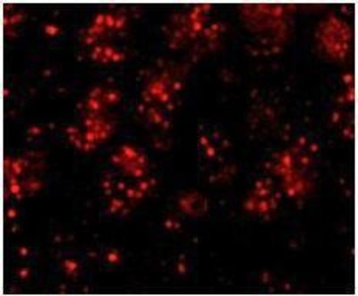 Immunocytochemistry/Immunofluorescence: PHF6 Antibody [NB100-68261] - Detection of Human PHF6 by Immunofluorescence. Sample: FFPE section of human skin carcinoma. Antibody: Affinity purified rabbit anti-PHF6 used at a dilution of 1:100. Detection: Red-fluorescent goat anti-rabbit IgG highly cross-adsorbed Antibody Hilyte PlusTM 555 used at a dilution of 1:100.