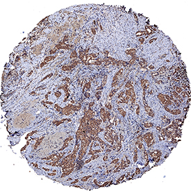 TM4SF1/L6  was detected in immersion fixed paraffin-embedded sections of human breast  cancer tissue using Mouse Anti-Human TM4SF1/L6 Monoclonal Antibody (Catalog #  MAB8164) at 5 µg/mL for 1 hour at room temperature  followed by incubation with the Anti-Mouse IgG VisUCyte™  HRP Polymer Antibody (Catalog #  VC001).  Tissue was stained using DAB (brown) and counterstained with hematoxylin  (blue).  Specific staining was  localized to cytoplasm in cancer cells. View our protocol for IHC  Staining with VisUCyte HRP Polymer Detection Reagents.  