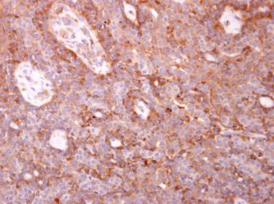Immunohistochemistry-Paraffin: Coronin 3 Antibody [NBP2-15968] - Paraffin-embedded human lung carcinoma. Coronin 1C antibody [C1C3] diluted at 1:500.