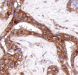 Collagen XXIII alpha 1 was detected in immersion fixed paraffin-embedded sections of human adenocarcinoma using Human Collagen XXIII alpha 1 Monoclonal Antibody (Catalog # MAB4165) at 25 µg/mL overnight at 4 °C. Tissue was stained using the Anti-Mouse HRP-DAB Cell & Tissue Staining Kit (brown; Catalog # CTS002) and counterstained with hematoxylin (blue). Specific staining was localized to cytoplasm. View our protocol for Chromogenic IHC Staining of Paraffin-embedded Tissue Sections.