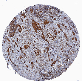 PDZK1 was detected in immersion fixed paraffin-embedded sections of human squamous cell carcinoma using Goat Anti-Mouse/Rat PDZK1 Antigen Affinity-purified Polyclonal Antibody (Catalog # AF5780) at 3 µg/mL overnight at 4 °C. Tissue was stained using the Anti-Goat HRP-DAB Cell & Tissue Staining Kit (brown; Catalog # CTS008) and counterstained with hematoxylin (blue). Specific staining was localized to cytoplasm in cancer cells. View our protocol for Chromogenic IHC Staining of Paraffin-embedded Tissue Sections.