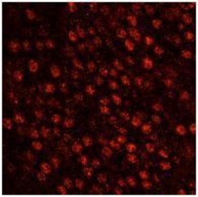 Immunocytochemistry/Immunofluorescence: SART3 Antibody [NB100-74648] - FFPE section of human pancreatic islet cell tumor.   Affinity purified rabbit anti-SART3 used at a dilution of 1:100. Detection: Red fluorescent goat anti-rabbit IgG highly cross-adsorbed Antibody Hilyte PlusTM 555 used at a dilution of 1:100.