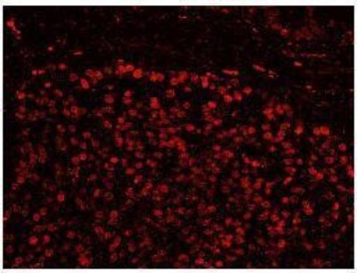 Immunocytochemistry/Immunofluorescence: SFRS14 Antibody [NB100-79849] - FFPE section of human prostate carcinoma.  Affinity purified rabbit anti-SFRS14 used at a dilution of 1:100. Detection: Red-fluorescent goat anti-rabbit IgG highly cross-adsorbed Antibody Hilyte PlusTM 555 used at  a dilution of 1:100.