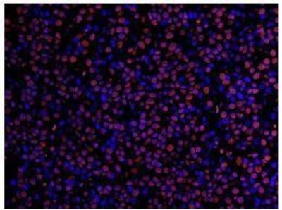 Immunocytochemistry/Immunofluorescence: Timeless Antibody [NB100-40853] - FFPE section of human breast carcinoma.  Affinity purified rabbit anti-Timeless used at a dilution of 1:100. Detection: Red-fluorescent Alexa Fluor 555 goat anti-rabbit IgG used at a dilution of 1:500.