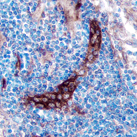 TSLP R was detected in immersion fixed paraffin-embedded sections of human lymph node using Goat Anti-Human TSLP R Antigen Affinity-purified Polyclonal Antibody (Catalog # AF981) at 5 µg/mL overnight at 4 °C. Tissue was stained using the Anti-Goat HRP-DAB Cell & Tissue Staining Kit (brown; Catalog # CTS008) and counterstained with hematoxylin (blue). Specific staining was localized to the plasma membrane. View our protocol for Chromogenic IHC Staining of Paraffin-embedded Tissue Sections.