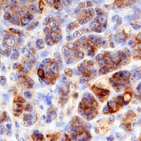 Plexin D1 was detected in immersion fixed paraffin-embedded sections of human melanoma using Goat Anti-Human Plexin D1 Antigen Affinity-purified Polyclonal Antibody (Catalog # AF4160) at 3 µg/mL overnight at 4 °C. Before incubation with the primary antibody, tissue was subjected to heat-induced epitope retrieval using Antigen Retrieval Reagent-Basic (Catalog # CTS013). Tissue was stained using the Anti-Goat HRP-DAB Cell & Tissue Staining Kit (brown; Catalog # CTS008) and counterstained with hematoxylin (blue). Specific staining was localized to plasma membranes. View our protocol for Chromogenic IHC Staining of Paraffin-embedded Tissue Sections.