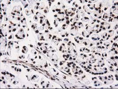 Immunohistochemistry-Paraffin: V-type proton ATPase subunit F Antibody (1B8) [NBP2-03498] - Staining of paraffin-embedded Adenocarcinoma of Human colon tissue using anti-V-type proton ATPase subunit F mouse monoclonal antibody.