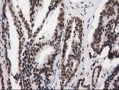 Immunohistochemistry-Paraffin: V-type proton ATPase subunit F Antibody (1B8) [NBP2-03498] - Staining of paraffin-embedded Carcinoma of Human prostate tissue using anti-V-type proton ATPase subunit F mouse monoclonal antibody.
