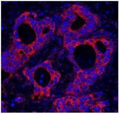 Immunocytochemistry/Immunofluorescence: PBXIP1 Antibody [NB100-81652] - FFPE section of human ovarian carcinoma.  Affinity purified rabbit anti-HPIP used at a dilution of 1:100. Detection: Red-fluorescent goat anti-rabbit IgG highly crossadsorbed Antibody Hilyte PlusTM 555 used at a  dilution of 1:100