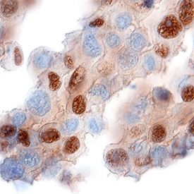 SOX10 was detected in immersion fixed paraffin-embedded sections of human melanoma tissue using Mouse Anti-Human/Rat SOX10 Monoclonal Antibody (Catalog # MAB2864) at 5 µg/mL for 1 hour at room temperature followed by incubation with the Anti-Mouse IgG VisUCyte™ HRP Polymer Antibody (Catalog # VC001). Tissue was stained using DAB (brown) and counterstained with hematoxylin (blue). Specific staining was localized to nuclei. View our protocol for IHC Staining with VisUCyte HRP Polymer Detection Reagents.