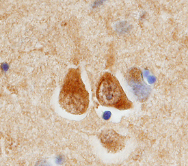 ECE‑2 was detected in immersion fixed paraffin-embedded sections of human brain (cortex) using 3 µg/mL Rat Anti-Human ECE‑2 Monoclonal Antibody (Catalog # MAB16451) overnight at4 °C. Tissue was stained with the Anti-Rat HRP-DAB Cell & Tissue Staining Kit (brown; Catalog # CTS017) and counterstained with hematoxylin (blue). View our protocol for Chromogenic IHC Staining of Paraffin-embedded Tissue Sections.