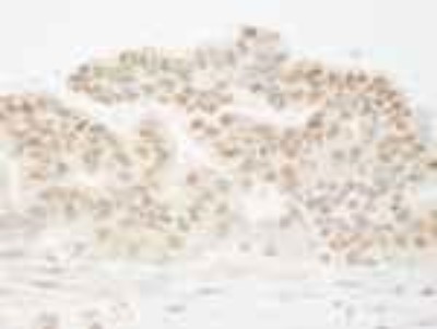 Immunohistochemistry-Paraffin: cleavage stimulation factor Antibody [NB100-60443] - FFPE section of human ovarian carcinoma.  NB100-60443 used at a dilution of 1:250.