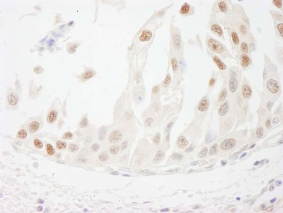Immunohistochemistry-Paraffin: cleavage stimulation factor Antibody [NB100-60443] - Human bladder cell carcinoma. Antibody used at a dilution of 1:1000 (1ug/ml).