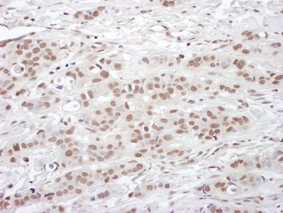 Immunohistochemistry: cleavage stimulation factor Antibody [NB100-60443] - Sample: FFPE section of human breast carcinoma. Antibody: Affinity purified rabbit anti-CSTF50 used at a dilution of 1:1,000 (1ug/ml). Detection: DAB