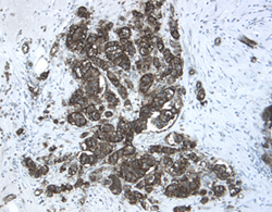 Chordin-like 2/CHRDL2 was detected in immersion fixed paraffin-embedded sections of human breast cancer tissue using 15 µg/mL Goat Anti-Human Chordin-like 2/CHRDL2 Antigen Affinity-purified Polyclonal Antibody (Catalog # AF2448) overnight at 4 °C. Tissue was stained with the Anti-Goat HRP-DAB Cell & Tissue Staining Kit  (brown; Catalog # CTS008) and counterstained with hematoxylin (blue). View our protocol for Chromogenic IHC Staining of Paraffin-embedded Tissue Sections.