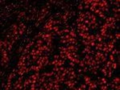 Immunocytochemistry/Immunofluorescence: HA95/AKAP8L Antibody [NB100-61606] - FFPE section of human breast carcinoma.  Affinity purified rabbit anti-AKAP8L/HA95 used at a dilution of 1:100.
