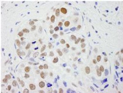 Immunohistochemistry-Paraffin: pre-mRNA cleavage factor I (59 kDa subunit) Antibody [NB100-61600] - FFPE section of human breast carcinoma.  Affinity purified rabbit anti-CPSF59 used at a dilution of 1:250.