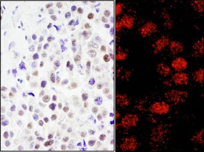 Immunohistochemistry: CoREST3/RCOR3 Antibody [NB100-60637] - Sample: FFPE sections of human testicular seminoma (left) and breast carcinoma (right). Antibody: Affinity purified rabbit anti- RCOR3 used at a dilution of 1:200 (1ug/ml) and 1:80 (2.5 ug/ml). Detection: DAB and Red-fluorescent Goat anti-Rabbit IgG-heavy