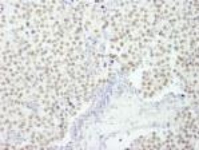 Immunohistochemistry-Paraffin: CoREST3/RCOR3 Antibody [NB100-60637] - FFPE section of human breast carcinoma.  Antibody at a dilution of 1:250.