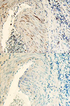 Tsukushi/TSK was detected in immersion fixed paraffin-embedded sections of human colon cancer tissue using Goat Anti-Human Tsukushi/TSK Antigen Affinity-purified Polyclonal Antibody (Catalog # AF3940) at 10 µg/mL overnight at 4 °C. Before incubation with the primary antibody, tissue was subjected to heat-induced epitope retrieval using Antigen Retrieval Reagent-Basic (Catalog # CTS013). Tissue was stained using the Anti-Goat HRP-DAB Cell & Tissue Staining Kit (brown; Catalog # CTS008) and counterstained with hematoxylin (blue). Lower panel shows a lack of labeling when primary antibodies are omitted and tissue is stained only with secondary antibody followed by incubation with detection reagents. Specific staining was localized to smooth muscle. View our protocol for Chromogenic IHC Staining of Paraffin-embedded Tissue Sections.
