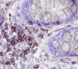 Neuromedin B R/NMBR was detected in immersion fixed paraffin-embedded sections of human colon cancer tissue using Human Neuromedin B R/NMBR Monoclonal Antibody (Catalog # MAB47281) at 15 µg/mL overnight at 4 °C. Before incubation with the primary antibody, tissue was subjected to heat-induced epitope retrieval using Antigen Retrieval Reagent-Basic (Catalog # CTS013). Tissue was stained using the Anti-Mouse HRP-DAB Cell & Tissue Staining Kit (brown; Catalog # CTS002) and counterstained with hematoxylin (blue). Specific staining was localized to plasma membranes. View our protocol for Chromogenic IHC Staining of Paraffin-embedded Tissue Sections.