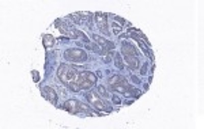 Immunohistochemistry-Paraffin: Coronin 3 Antibody [NBP2-27289] - Staining with anti-CORO1C antibody in breast cancer tissue at 1:100 dilution.