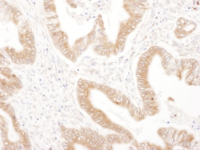 Immunohistochemistry: Ribophorin II Antibody [NBP2-32178] - Sample: FFPE section of human prostate carcinoma. Antibody: Affinity purified rabbit anti- RPN2 used at a dilution of 1:1,000 (1ug/ml). Detection: DAB. Counterstain: IHC Hematoxylin (blue).