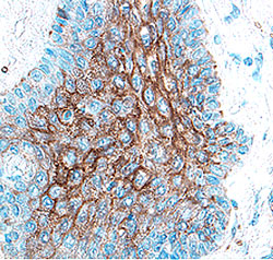 Cathepsin V was detected in immersion fixed paraffin-embedded sections of human breast cancer tissue using 1.7 µg/mL Goat Anti-Human Cathepsin V Antigen Affinity-purified Polyclonal Antibody (Catalog # AF1080) overnight at 4 °C. Tissue was stained with the Anti-Goat HRP-DAB Cell & Tissue Staining Kit  (brown; Catalog # CTS008) and counterstained with hematoxylin (blue). View our protocol for Chromogenic IHC Staining of Paraffin-embedded Tissue Sections.