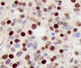 p27/Kip1 was detected in immersion fixed paraffin-embedded sections of human prostate cancer tissue using 25 µg/mL Rat Anti-Human/Mouse/Rat p27/Kip1 Monoclonal Antibody (Catalog # MAB22561) overnight at 4 °C. Tissue was stained with the Human p27 Immunohistochemistry Detection Kit (brown; Catalog # CTS2256) and counterstained with hematoxylin (blue). View our protocol for Chromogenic IHC Staining of Paraffin-embedded Tissue Sections.