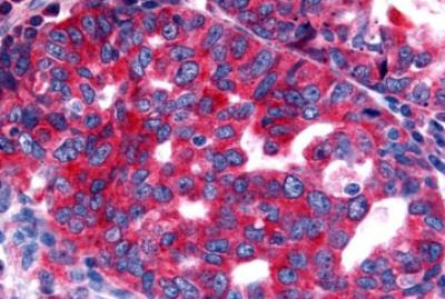 Immunohistochemistry-Paraffin: Neurotensin Receptor 2 Antibody [NLS3747] - Human Ovary, Carcinoma.formalin-fixed, paraffin-embedded tissue after heat-induced antigen retrieval.