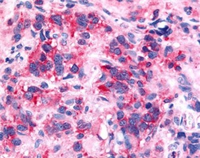 Immunohistochemistry-Paraffin: Neurotensin Receptor 2 Antibody [NLS3747] - Analysis of anti-NTSR2 / NTR2 antibody with human brain, glioblastoma.