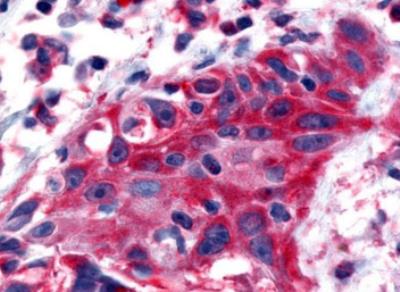 Immunohistochemistry-Paraffin: Neurotensin Receptor 2 Antibody [NLS3747] - Human Skin, Melanoma formalin-fixed, paraffin-embedded tissue after heat-induced antigen retrieval.