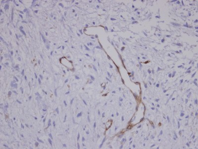 Immunohistochemistry-Paraffin: Coronin 3 Antibody [NBP1-31283] - Paraffin-embedded Sarcoma meta to brain Blood Vessel, using antibody at 1:100 dilution.