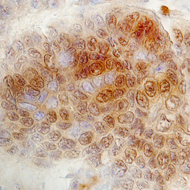 FoxK1 was detected in immersion fixed paraffin-embedded sections of human colon using Human FoxK1 Antigen Affinity-purified Polyclonal Antibody (Catalog # AF6366) at 10 µg/mL overnight at 4 °C. Before incubation with the primary antibody, tissue was subjected to heat-induced epitope retrieval using Antigen Retrieval Reagent-Basic (Catalog # CTS013). Tissue was stained using the Anti-Goat HRP-DAB Cell & Tissue Staining Kit (brown; Catalog # CTS008) and counterstained with hematoxylin (blue). Specific staining was localized to epithelial cell nuclei and cytoplasm. View our protocol for Chromogenic IHC Staining of Paraffin-embedded Tissue Sections.