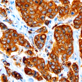 AG‑3 was detected in immersion fixed paraffin-embedded sections of human breast using Mouse Anti‑Human AG‑3 Monoclonal Antibody (Catalog # MAB6307) at 15 µg/mL overnight at 4 °C. Before incubation with the primary antibody, tissue was subjected to heat-induced epitope retrieval using Antigen Retrieval Reagent-Basic (Catalog # CTS013). Tissue was stained using the Anti-Mouse HRP-DAB Cell & Tissue Staining Kit (brown; Catalog # CTS002) and counterstained with hematoxylin (blue). Specific staining was localized to cytoplasm of glandular cells. View our protocol for Chromogenic IHC Staining of Paraffin-embedded Tissue Sections.