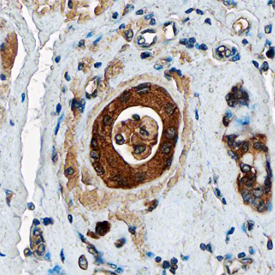 AG‑3 was detected in immersion fixed paraffin-embedded sections of human breast using Sheep Anti-Human AG‑3 Antigen Affinity-purified Polyclonal Antibody (Catalog # AF6307) at 3 µg/mL overnight at 4 °C. Tissue was stained using the Anti-Sheep HRP-DAB Cell & Tissue Staining Kit (brown; Catalog # CTS019) and counterstained with hematoxylin (blue). Specific staining was localized to epithelial cells. View our protocol for Chromogenic IHC Staining of Paraffin-embedded Tissue Sections.