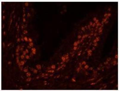 Immunocytochemistry/Immunofluorescence: USP47 Antibody [NB100-57487] - FFPE section of human prostate adenocarcinoma  Affinity purified rabbit anti-USP47 used at a dilution of 1:100. Detection: Red-fluorescent Alexa Fluor 555 goat anti-rabbit IgG used at a dilution of 1:500.