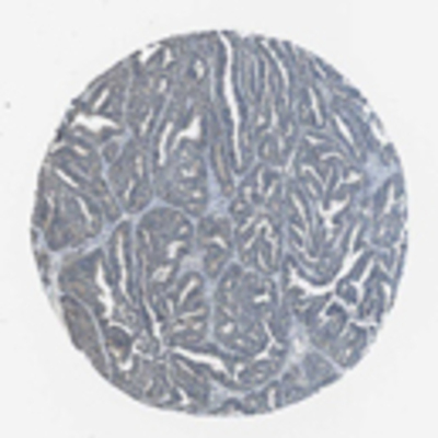 Immunohistochemistry: DCLK3 Antibody [21890002] - Normal tissues generally displayed weak to moderate cytoplasmic and occasional nuclear positivity. Ciliated cells in airways and fallopian tube exhibited distinct membranous staining. Cells for example in liver, prostate and spleen were negative. Colo-rectal and endometrial cancers exhibited some moderately stained cases while malignant gliomas, ovarian and stomach cancers showed several weakly immunoreactive samples. Remaining malignant tissues were mainly negative.  Image and statement courtesy of the Human Protein Atlas (HPA).
