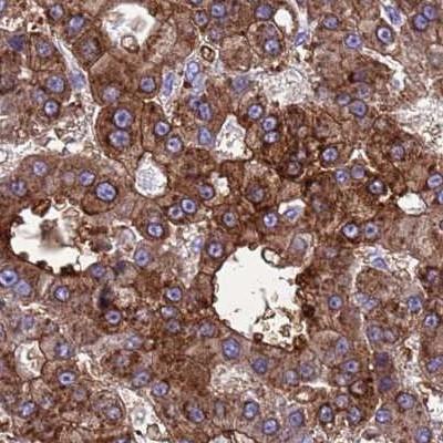 Immunohistochemistry: C2orf27B Antibody [NBP2-46706] - Staining of human liver cancer tissue.