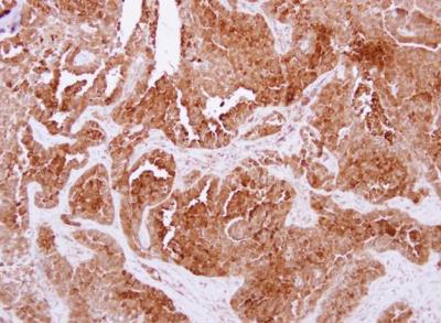 Immunohistochemistry-Paraffin: Niemann-Pick type C2 Antibody [NBP2-15044] - Protein at cytoplasm on lung carcinoma.