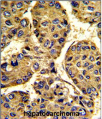 Immunohistochemistry-Paraffin: Asporin Antibody [NBP2-30071] - Formalin-fixed and paraffin-embedded human hepatocarcinoma with ASPN Antibody (Center), which was peroxidase-conjugated to the secondary antibody, followed by DAB staining. This data demonstrates the use of this antibody for immunohistochemistry; clinical relevance has not been evaluated.